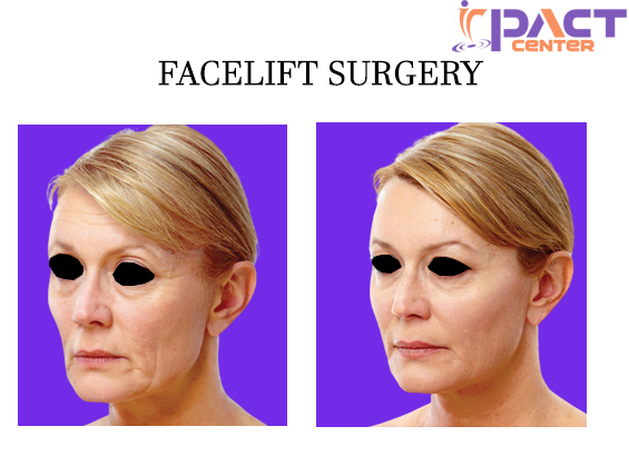 Facelift Surgery for Younger Appearance in Your Face